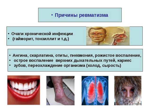 Причины ревматизма Причины ревматизма