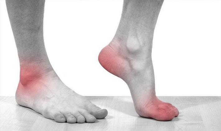 Боли в суставах пальцев ног при подагре Подагра на ногах