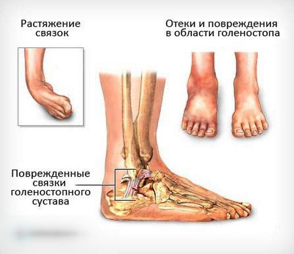 Растяжение связок голеностопного сустава Растяжение связок стопы