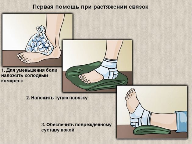 Первая помощь при растяжении связок Помощь при растяжении связок