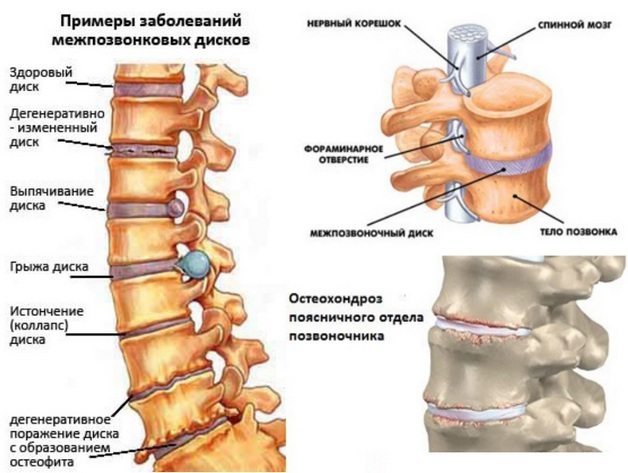 Остеохондроз поясничного отдела позвоночника Остеохондроз поясничного отдела