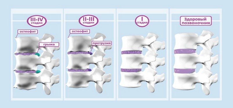 Стадии остеохондроза позвоночника Стадии остеохондроза