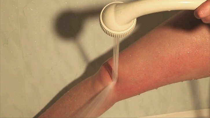 Гидромассаж коленного сустава Гидромассаж колена