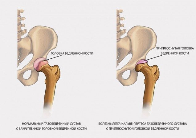 Здоровый тазобедренный сустав и некроз головки Асептический некроз головки бедренной кости