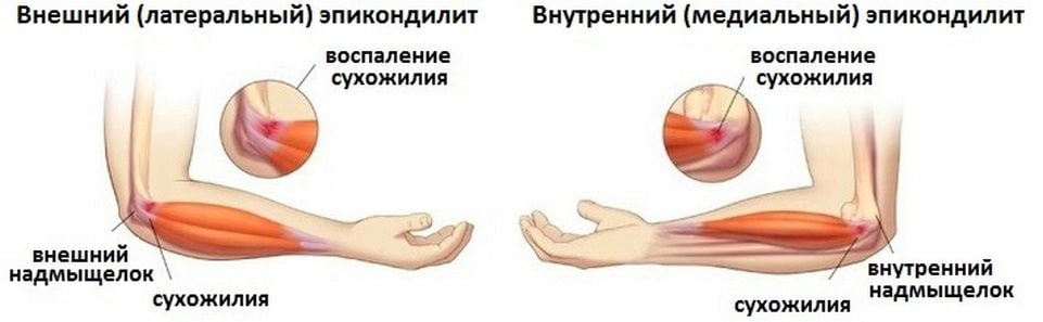 Латеральный и медиальный эпикондилит локтевого сустава Латеральный и медиальный эпикондилит