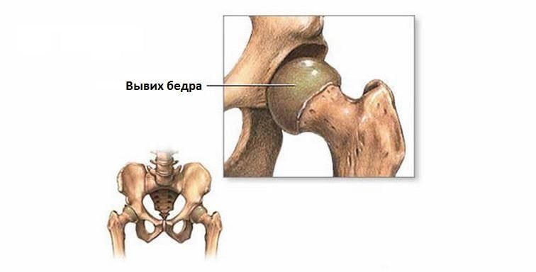 Вывих тазобедренного сустава Вывих бедра