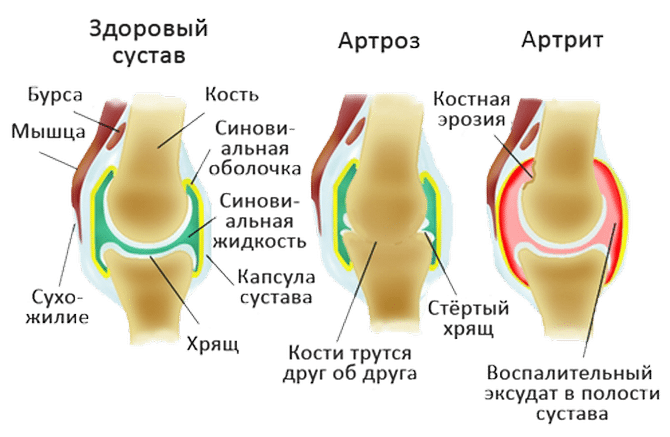 Артрит и Артроз