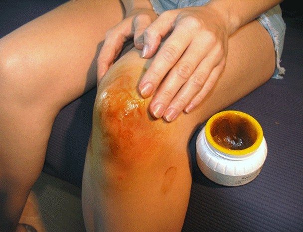 Массаж коленного сустава с медом Массаж колена с медом