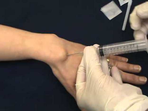 Прокол гигромы запястья Прокол гигромы