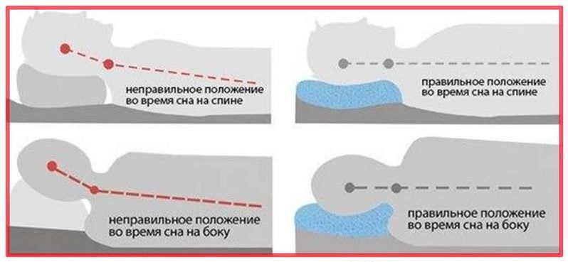 Правильно положение при шейном остеохондрозе