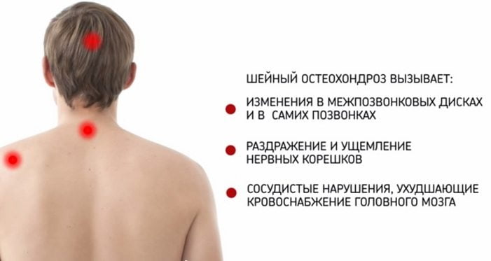 Основные симптомы шейного остеохондроза Синдромы остеохондроза