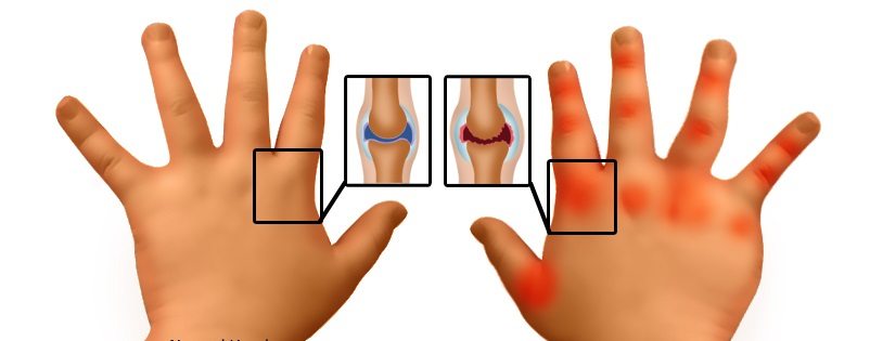 Ревматоидный артрит рук у детей Ревматоидный артрит рук