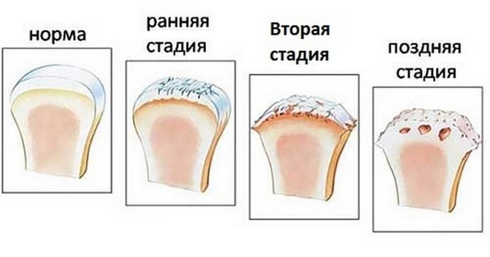 Стадии развития артроза