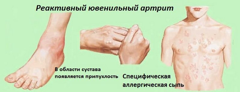 Реактивный ювенильный артрит