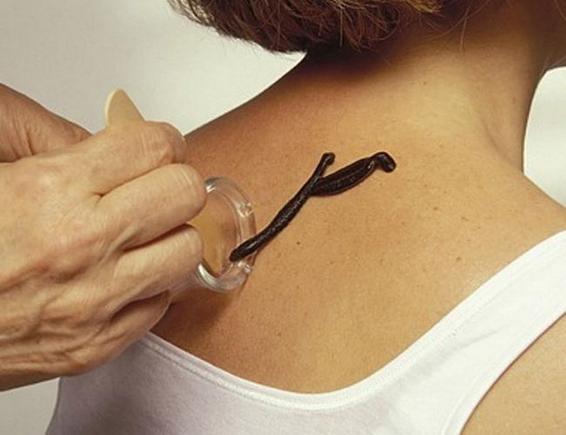 Пиявки при остеохондрозе