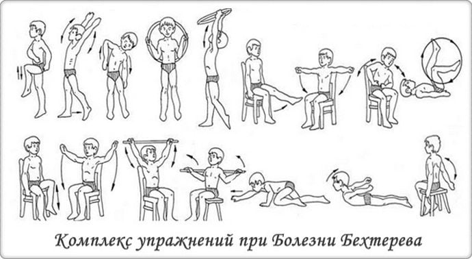 ЛФК при болезни Бехтерева
