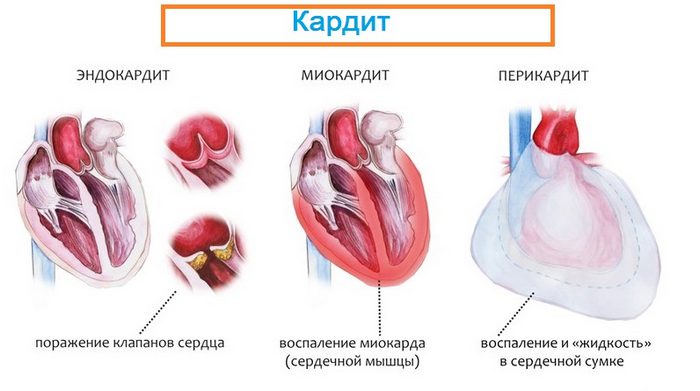 Разновидности кардита Кардит