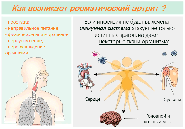 Механизм возникновения ревматического артрита Как возникает ревматический артрит