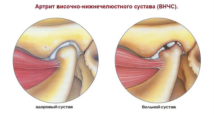 Отличия здорового височно-нижнечелюстного сустава от пораженного артритом Артрит височно-нижнечелюстного сустава